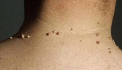 Reason -as a papilloma appearance on the human body