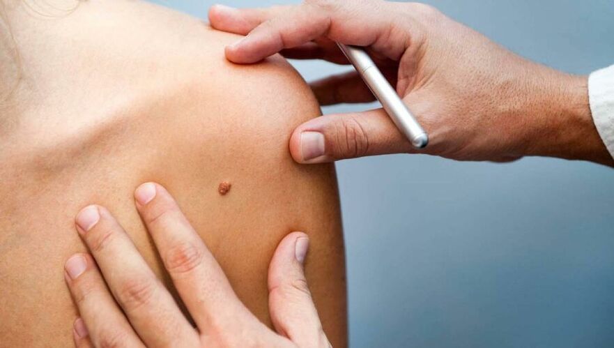 Dermatologists examine patients with papillomas