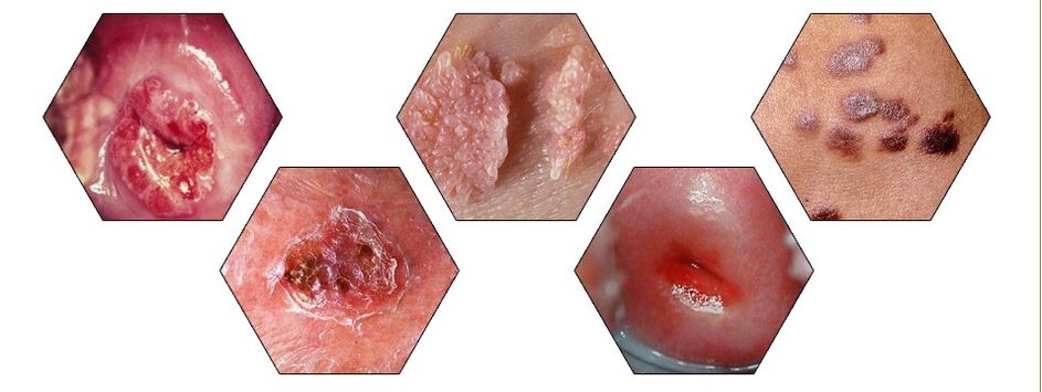 dangerous type of papilloma