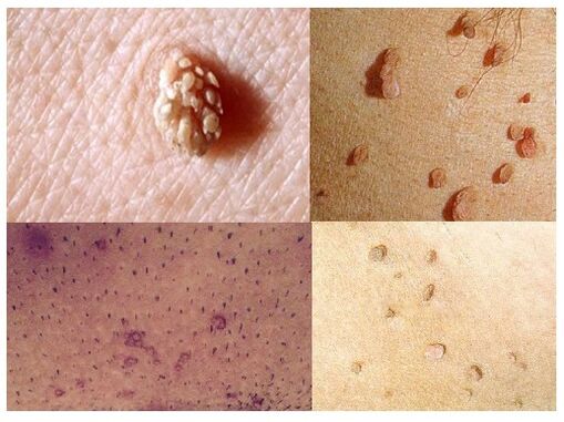 genital warts on the body