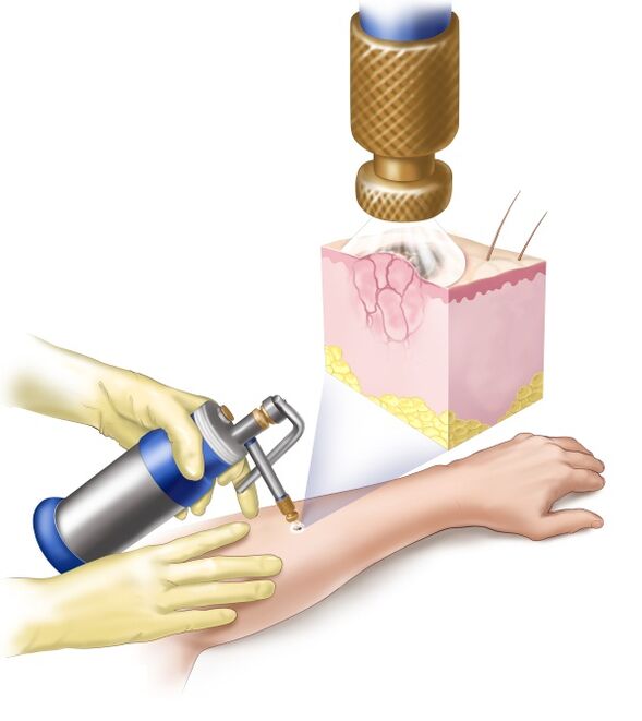 papilloma removal with liquid nitrogen