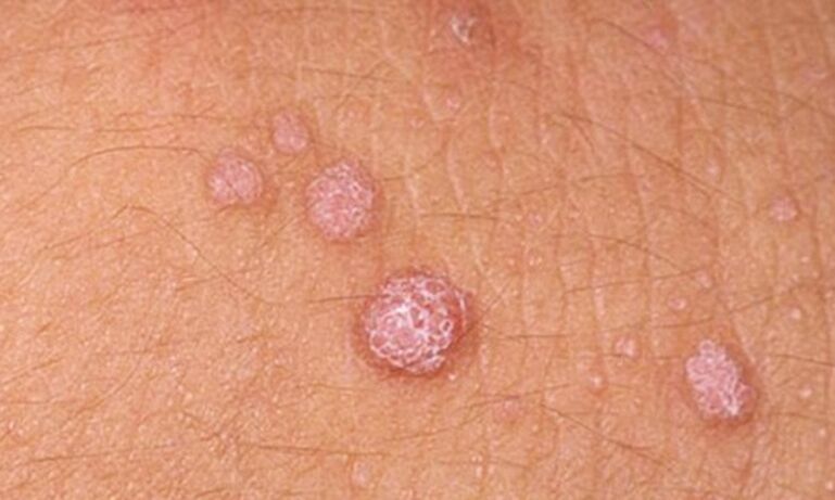 HPV leads to the appearance of skin papillomas