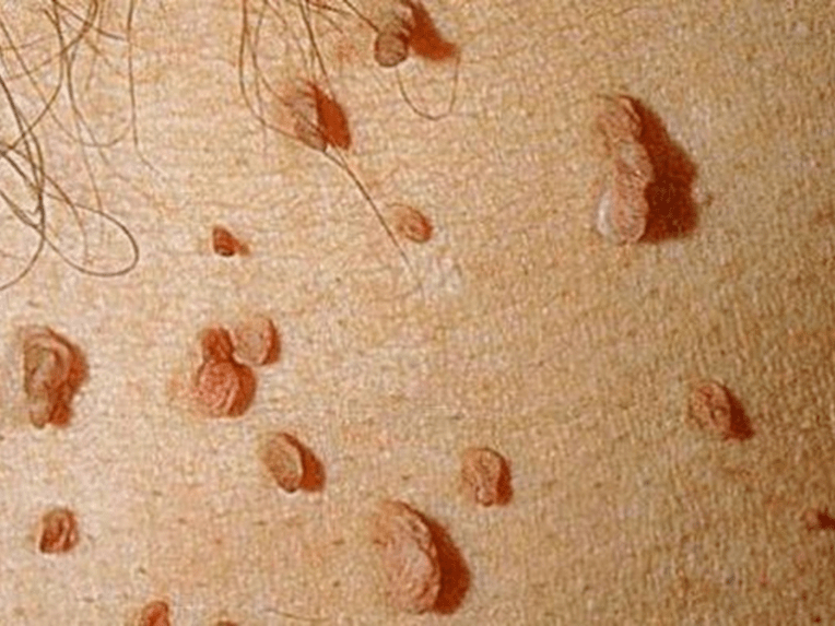 Papilloma on the body