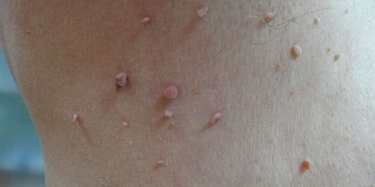 Papilloma