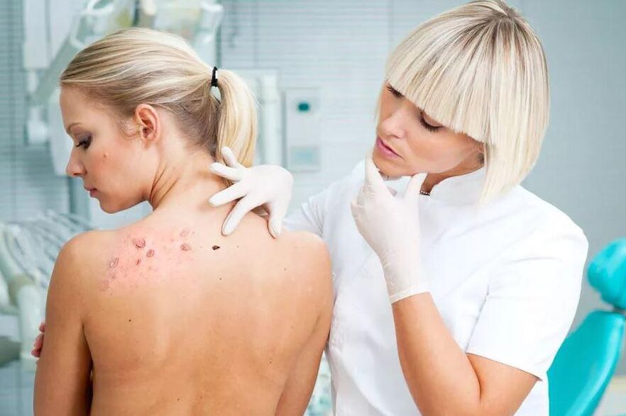 papilloma on the back