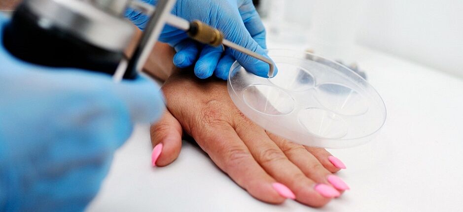 professional wart removal on hands