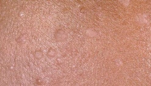 flat condyloma on human skin
