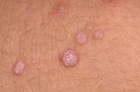human papillomavirus symptoms