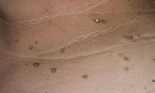manifestations of human papillomavirus
