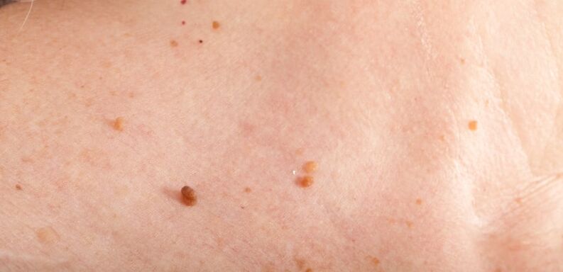 Papilloma on the body