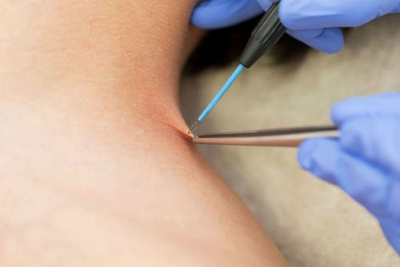 Procedure to remove papilloma using electrocoagulation