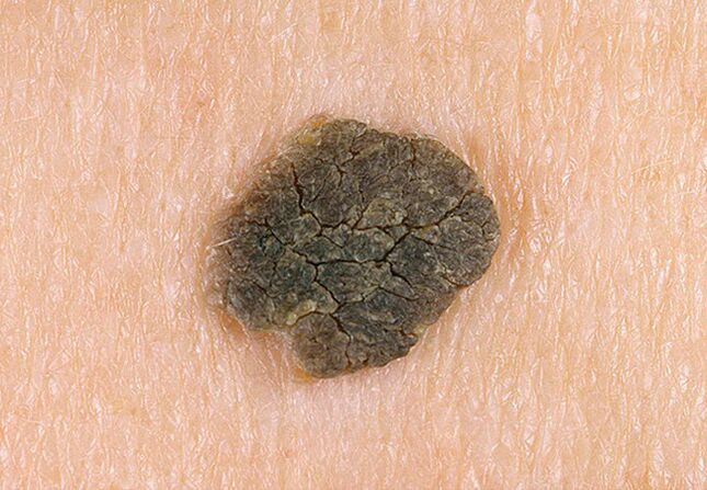 black warts on the skin