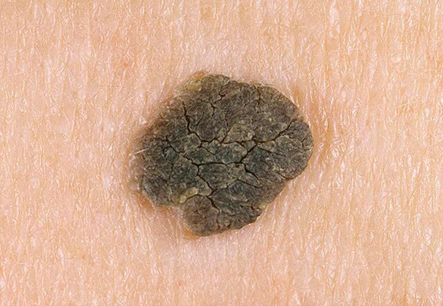 warts on the skin