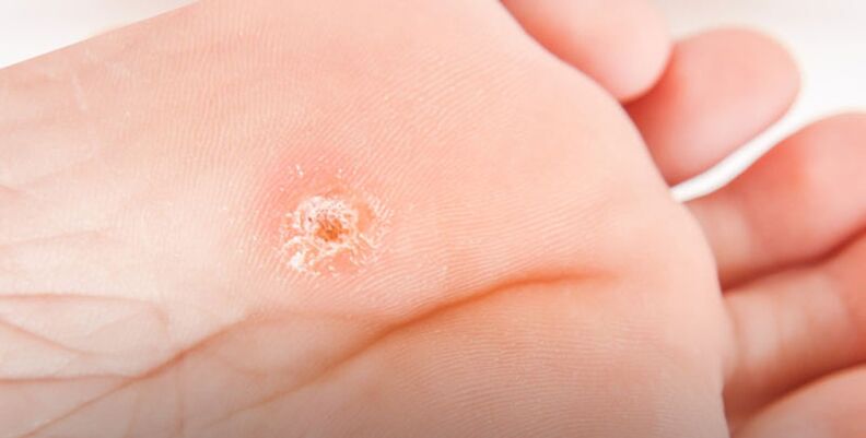 Plantar warts on the feet