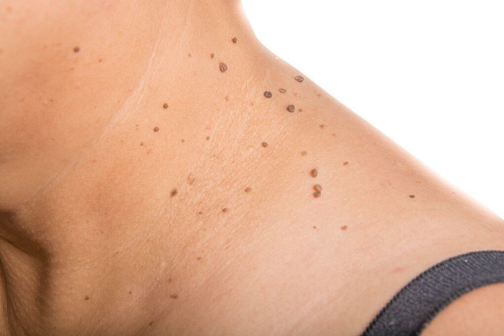 HPV complications