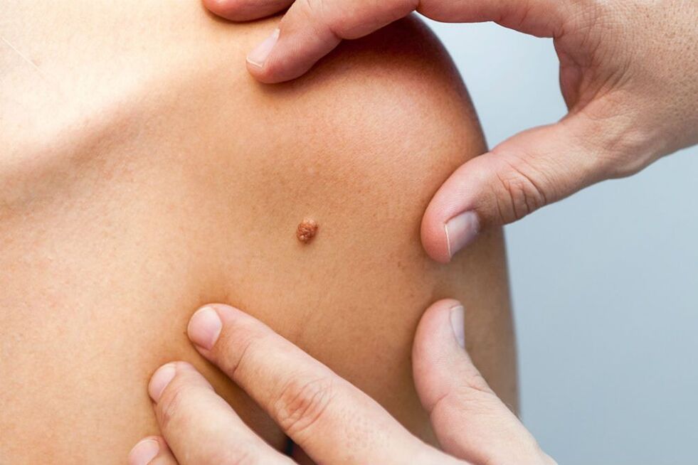 papilloma on the human body