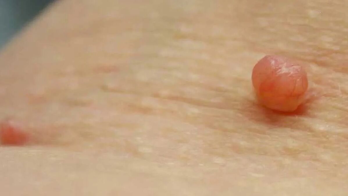 Papilloma removal at home