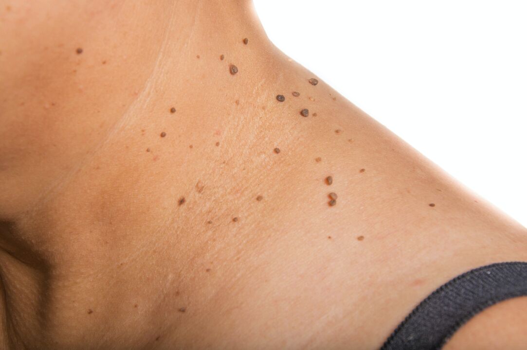 distribution of papilloma on the neck