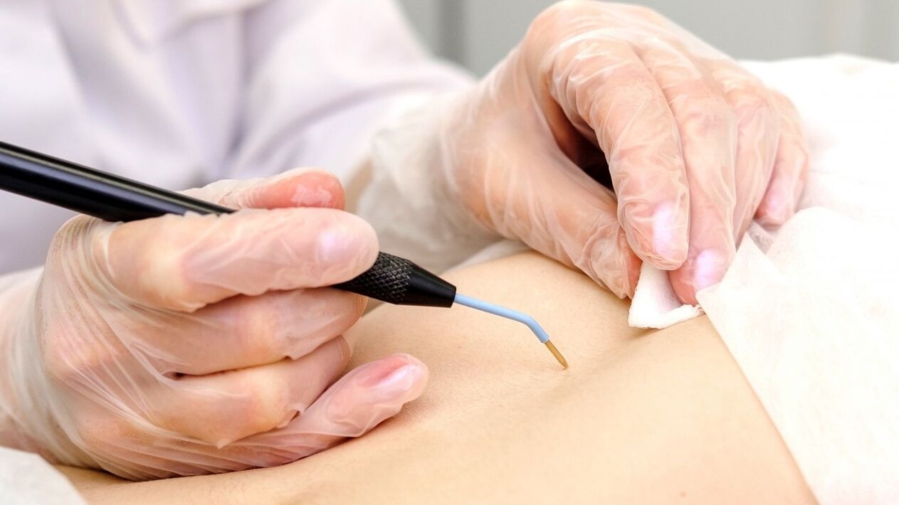how to remove papilloma