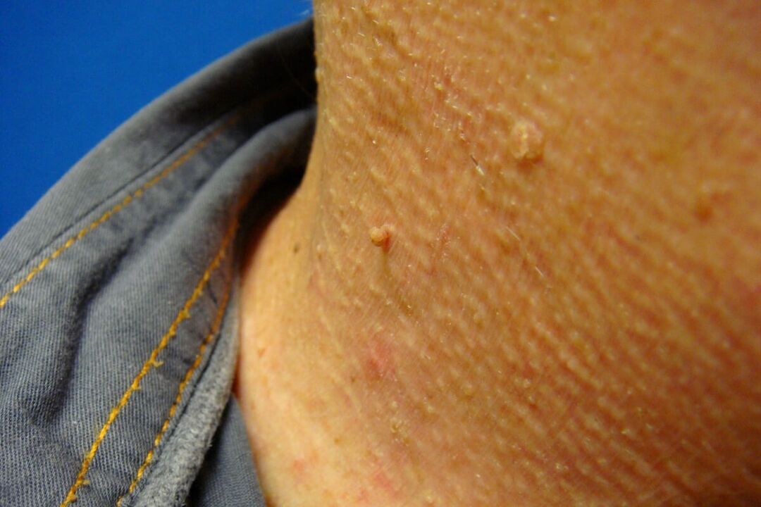 human neck papilloma